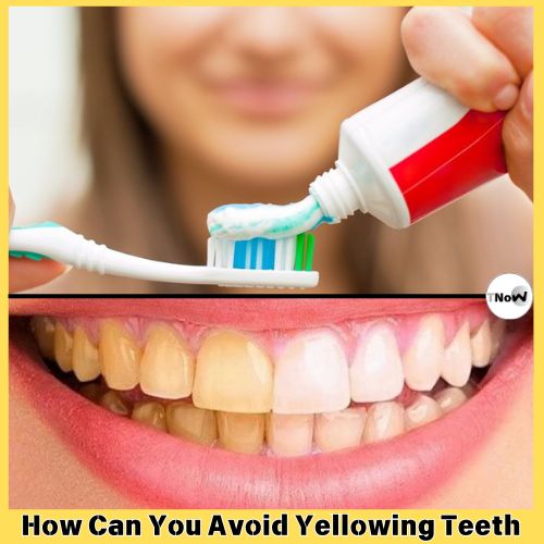 How Can You Avoid Yellowing Teeth